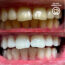 Efekty wybielania zębów